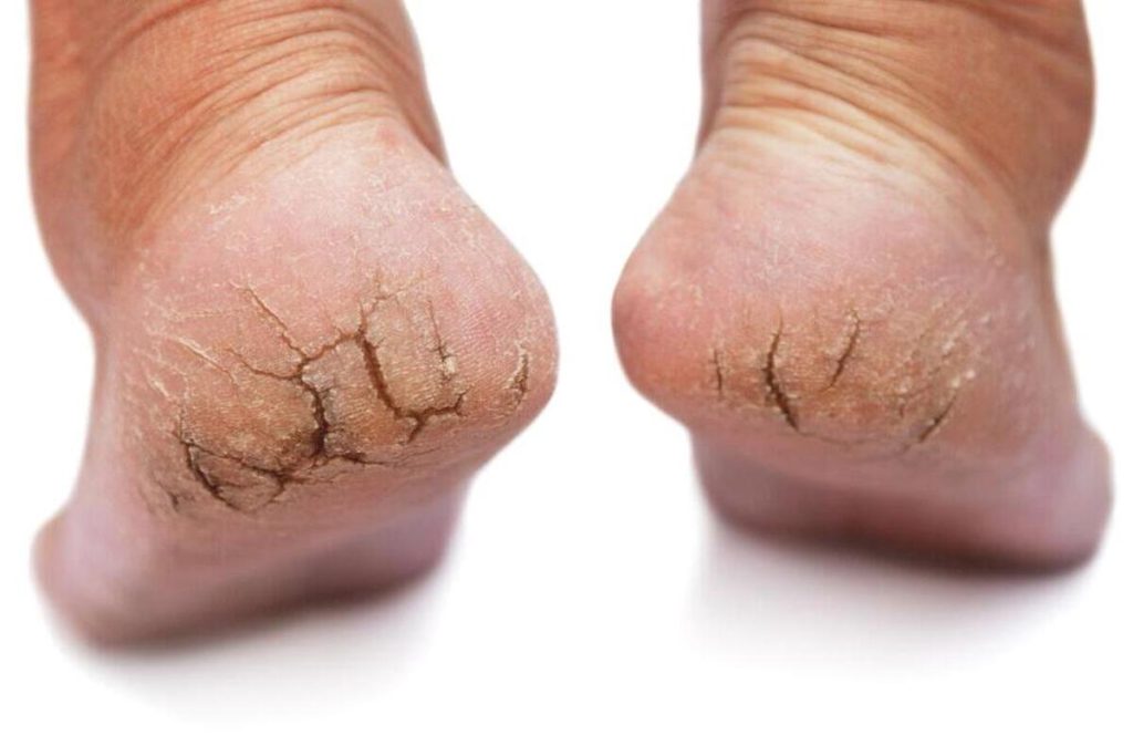 Artikel ini membahas mengenai beberapa tips mengatasi kaki kering dan juga pecah-pecah yang bisa Anda coba lakukan.